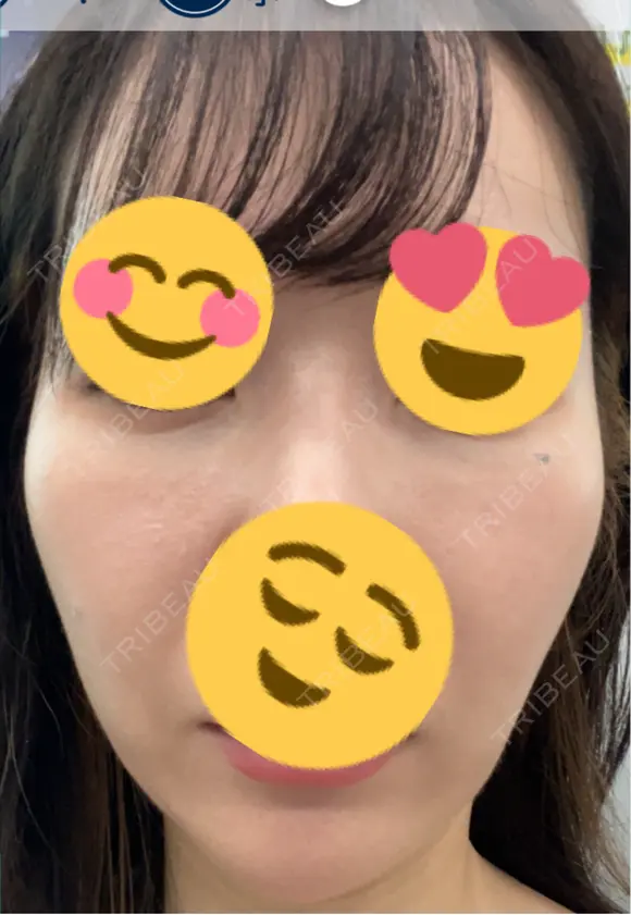 その他（輪郭） ARTE BEAUTY CLINIC DAY 7 メイン用