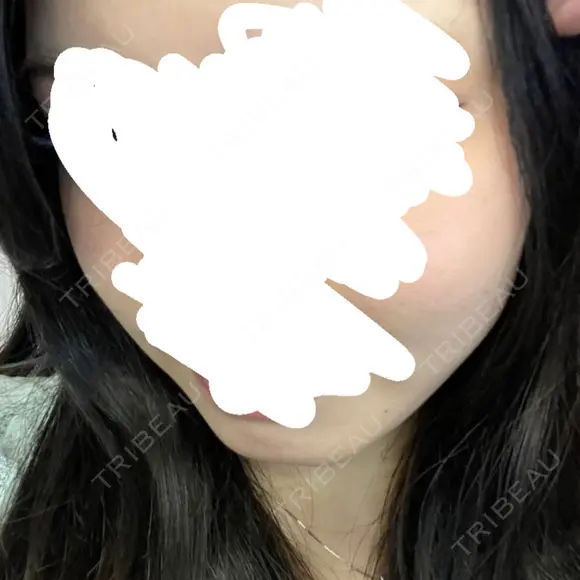 その他（肌） LUNA BEAUTY CLINIC 池袋駅前院 DAY 10 メイン用