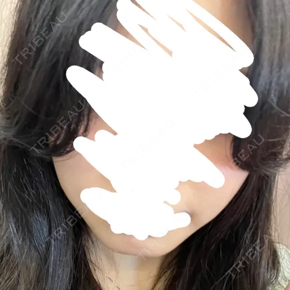 その他（肌） LUNA BEAUTY CLINIC 池袋駅前院 DAY 10 メイン用