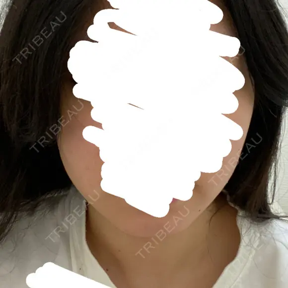 その他（肌） LUNA BEAUTY CLINIC 池袋駅前院 AFTER メイン用