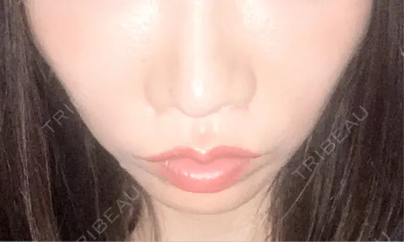 ヒアルロン酸注入（唇） / ボトックス（口角） おおたかの森ビューティークリニック AFTER メイン用