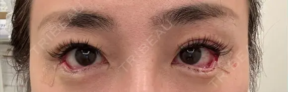 目尻切開 / タレ目形成・グラマラスライン（埋没） LOUIS CLINIC 二子玉川院【ルイクリニック】 DAY 0 メイン用