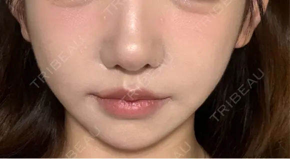 ボトックス（エラ・小顔） L‘amour clinic Tokyo【ラムールクリニック東京】 DAY 9 メイン用