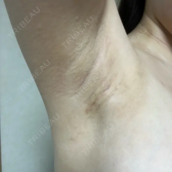 豊胸（シリコンバッグ） / 豊胸（脂肪注入） / 豊胸（シリコン＋脂肪併用） / その他（胸） お茶の水美容形成クリニック DAY 22 メイン用