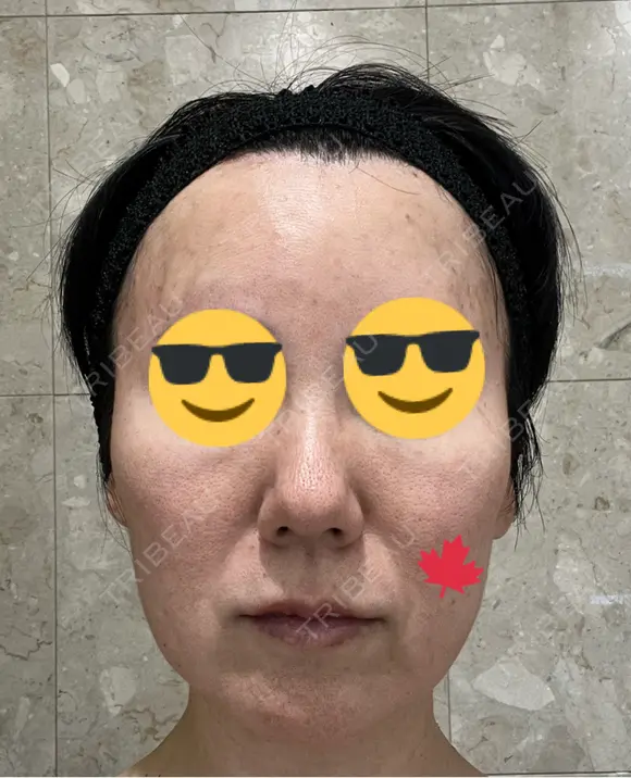 シミ取りレーザー / ピコスポット Olino美容外科・美容皮膚科 AFTER メイン用