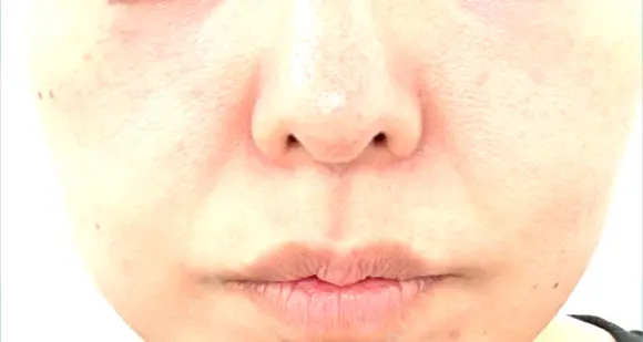 小鼻縮小（切開） / 鼻尖縮小 / 鼻柱下降・鼻唇角形成（猫手術） 東京シンデレラ美容外科 池袋院 AFTER メイン用