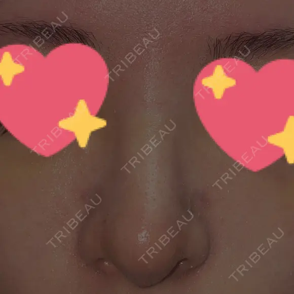 鼻尖形成（切開） / 軟骨移植 / 骨切幅寄せ / プロテーゼ除去 9BeautyClinic DAY 8 メイン用