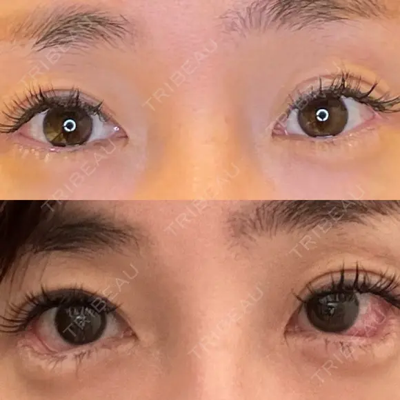 目尻切開 / タレ目形成・グラマラスライン（埋没） LOUIS CLINIC 二子玉川院【ルイクリニック】 DAY 1 メイン用