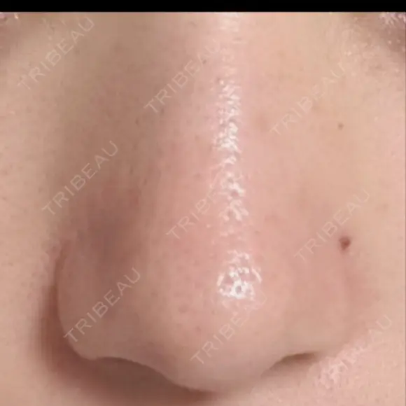 鼻尖形成（切開） / 小鼻縮小（切開） / その他（鼻） 東京形成美容外科 船橋院 DAY 214 メイン用