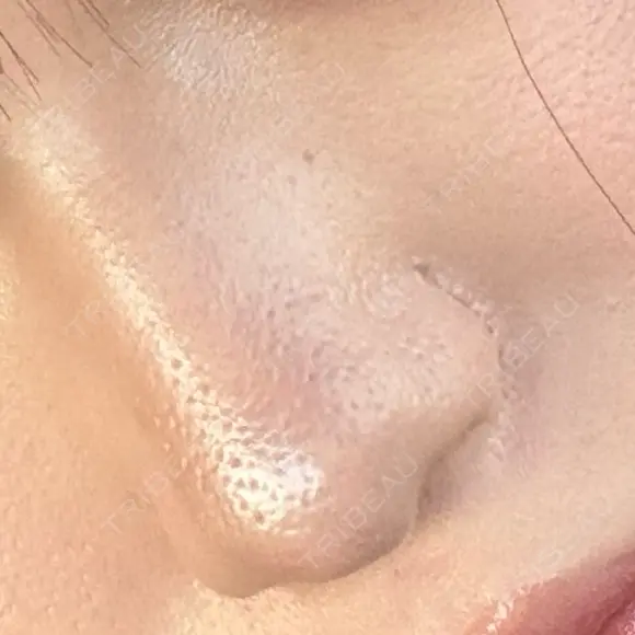 鼻尖形成（切開） / 小鼻縮小（切開） / その他（鼻） 東京形成美容外科 船橋院 DAY 214 メイン用