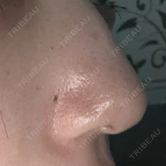 鼻尖形成（切開） / 小鼻縮小（切開） / その他（鼻） 東京形成美容外科 船橋院 DAY 214 メイン用