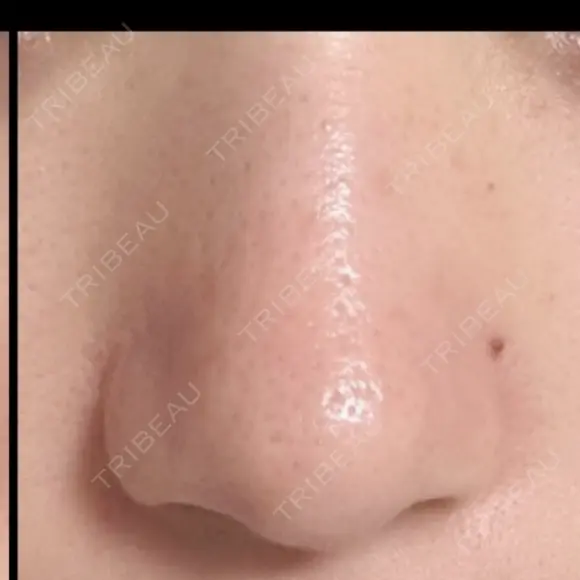 鼻尖形成（切開） / 小鼻縮小（切開） / その他（鼻） 東京形成美容外科 船橋院 DAY 214 メイン用