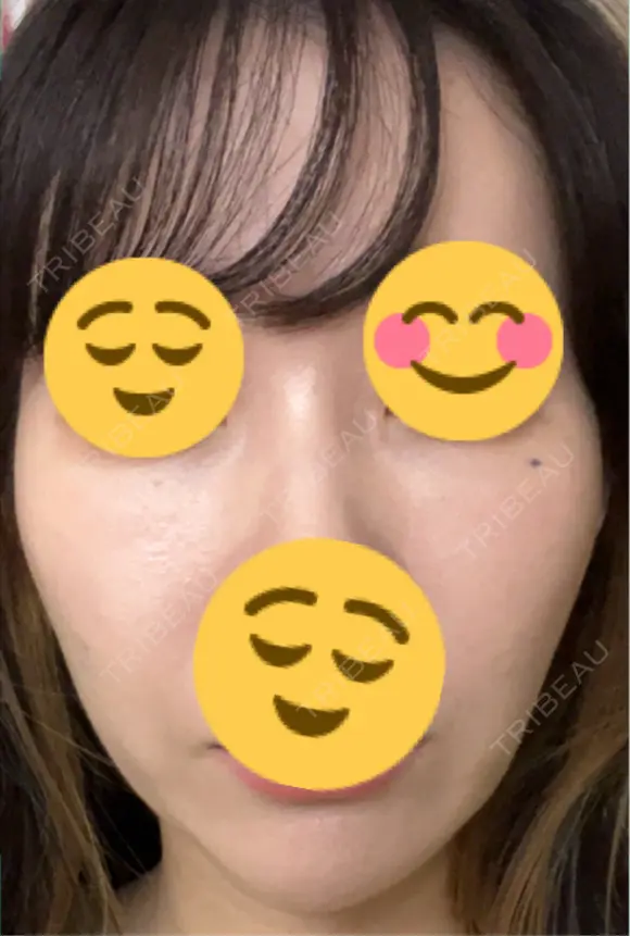 その他（輪郭） ARTE BEAUTY CLINIC DAY 10 メイン用