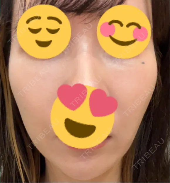 その他（輪郭） ARTE BEAUTY CLINIC AFTER メイン用