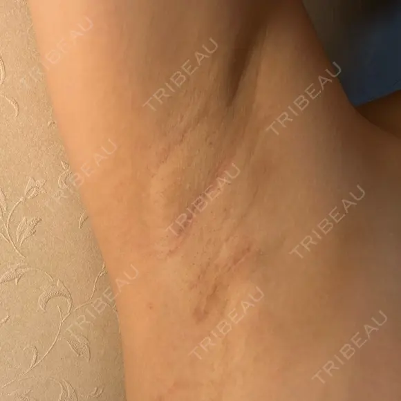 豊胸（シリコンバッグ） / 豊胸（脂肪注入） / 豊胸（シリコン＋脂肪併用） / その他（胸） お茶の水美容形成クリニック DAY 26 メイン用