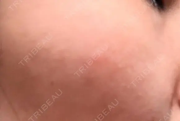 シミ取りレーザー / その他（目元） 共立美容外科 仙台院 DAY 10 メイン用