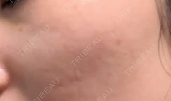 シミ取りレーザー / その他（目元） 共立美容外科 仙台院 DAY 10 メイン用