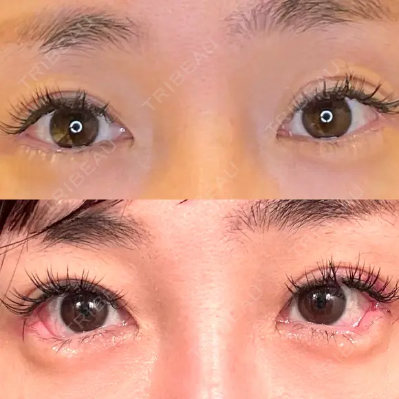 目尻切開 / タレ目形成・グラマラスライン（埋没） LOUIS CLINIC 二子玉川院【ルイクリニック】 DAY 4 メイン用