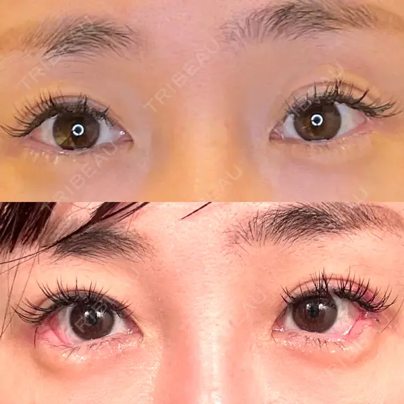 目尻切開 / タレ目形成・グラマラスライン（埋没） LOUIS CLINIC 二子玉川院【ルイクリニック】 DAY 2 メイン用