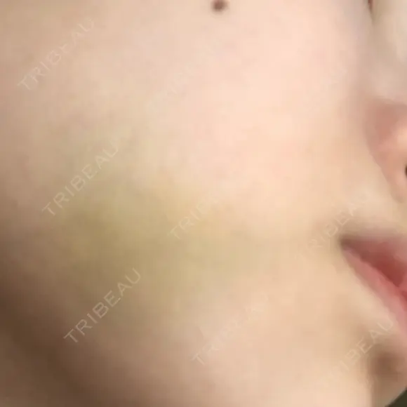 バッカルファット除去 ブルームクリニック（BLOOM CLINIC） DAY 3 メイン用