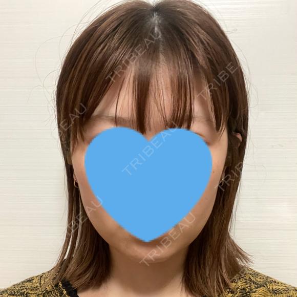 ボトックス（エラ・小顔） TCB東京中央美容外科 自由が丘院 DAY 0 メイン用