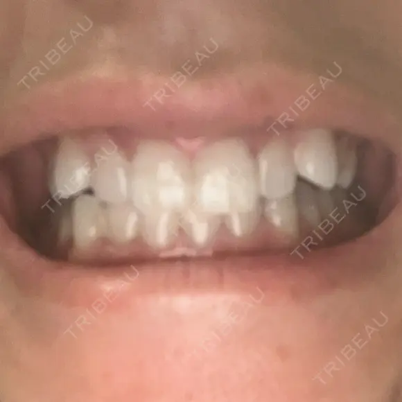 ホワイトニング 緑のテラス歯科クリニック AFTER メイン用