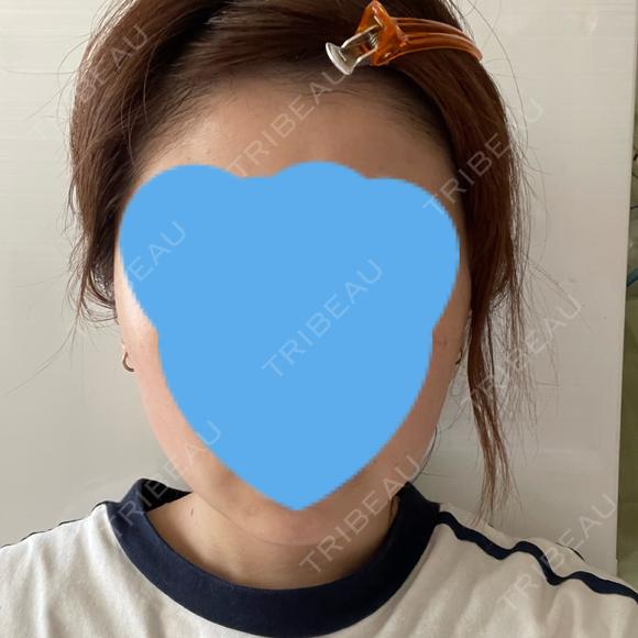 ボトックス（エラ・小顔） TCB東京中央美容外科 自由が丘院 AFTER メイン用