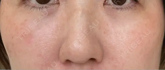 クマ治療 / 下まぶたの脂肪取り ROOTS Clinic DAY 19 メイン用