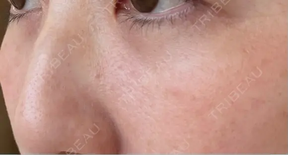 クマ治療 / 下まぶたの脂肪取り ROOTS Clinic DAY 19 メイン用