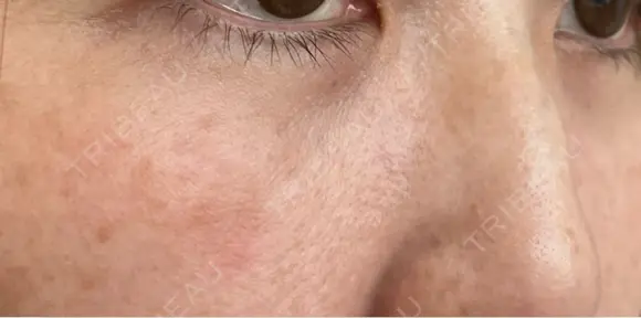 クマ治療 / 下まぶたの脂肪取り ROOTS Clinic DAY 19 メイン用