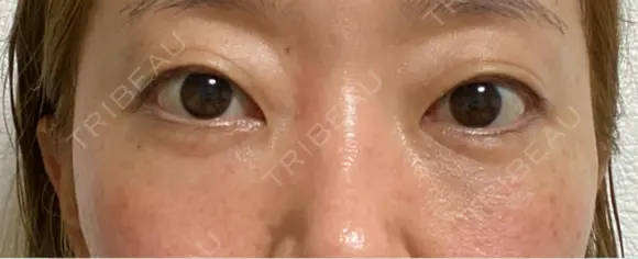 クマ治療 / 下まぶたたるみ取り / 下まぶたの脂肪取り / 脂肪注入（目の下） 湘南美容クリニック 千葉センシティ院 AFTER メイン用