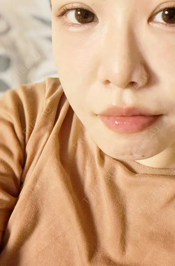 ボトックス（口角） おおたかの森ビューティークリニック DAY 6 メイン用