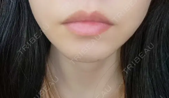 ボトックス（口角） おおたかの森ビューティークリニック DAY 9 メイン用