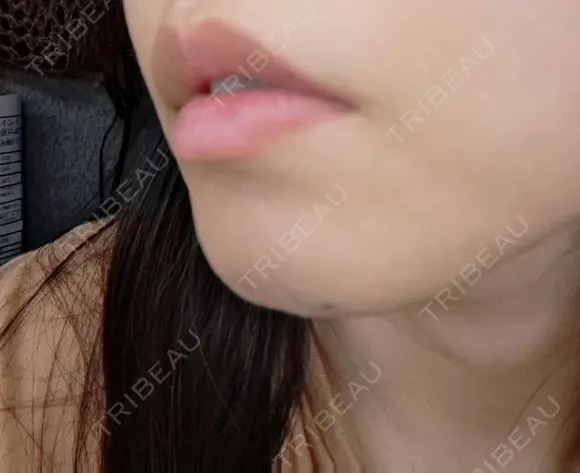 ボトックス（口角） おおたかの森ビューティークリニック DAY 9 メイン用