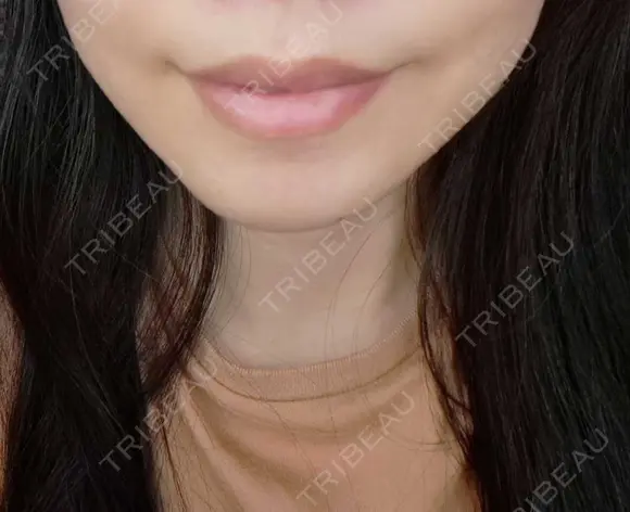 ボトックス（口角） おおたかの森ビューティークリニック DAY 9 メイン用