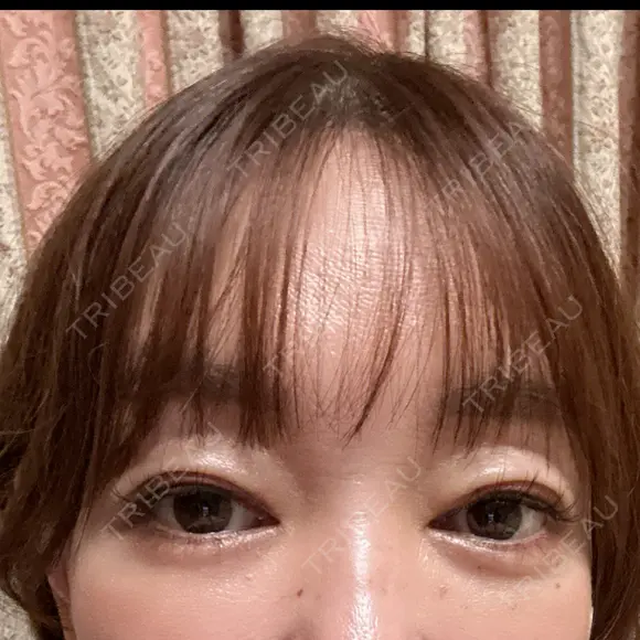 二重埋没 / ほくろ・いぼ切除（肌） / 自然癒着法 / ボトックス（眉間） / ボトックス（目尻） / ボトックス（人中） CLINIC W DAY 27 メイン用