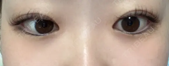 二重埋没 東京シンデレラ美容外科 大宮院 AFTER メイン用