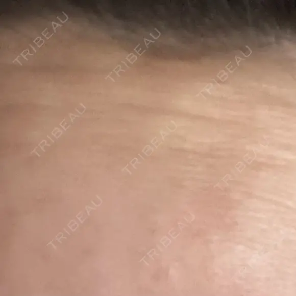 ボトックス（額） / その他（鼻） TCB東京中央美容外科 盛岡院 AFTER メイン用