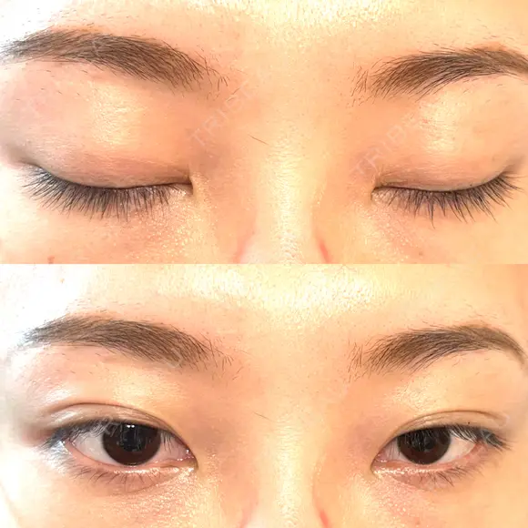 二重埋没 湘南美容クリニック 西葛西院 DAY 28 メイン用