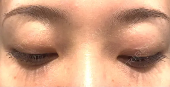 二重埋没 湘南美容クリニック 西葛西院 AFTER メイン用