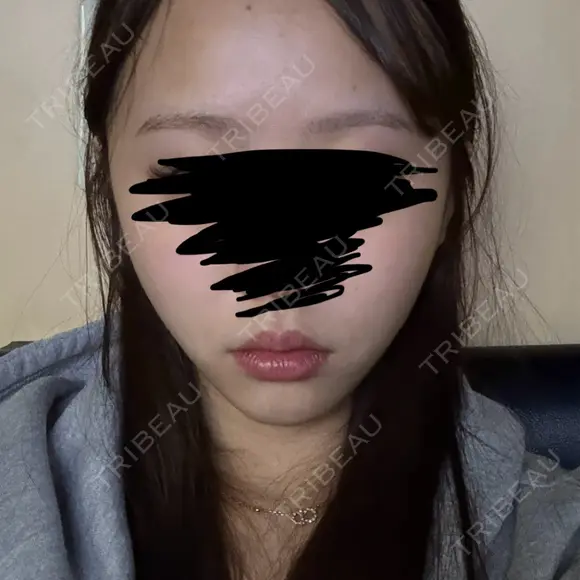 糸リフト / 脂肪吸引（顔） / ジョールファット除去 / ヒアルロン酸注入（あご） SEA CLINIC（シークリニック） DAY 59 メイン用