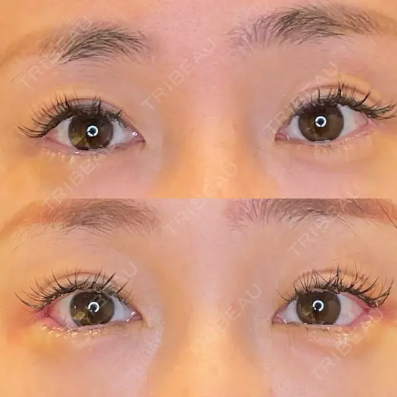 目尻切開 / タレ目形成・グラマラスライン（埋没） LOUIS CLINIC 二子玉川院【ルイクリニック】 DAY 9 メイン用