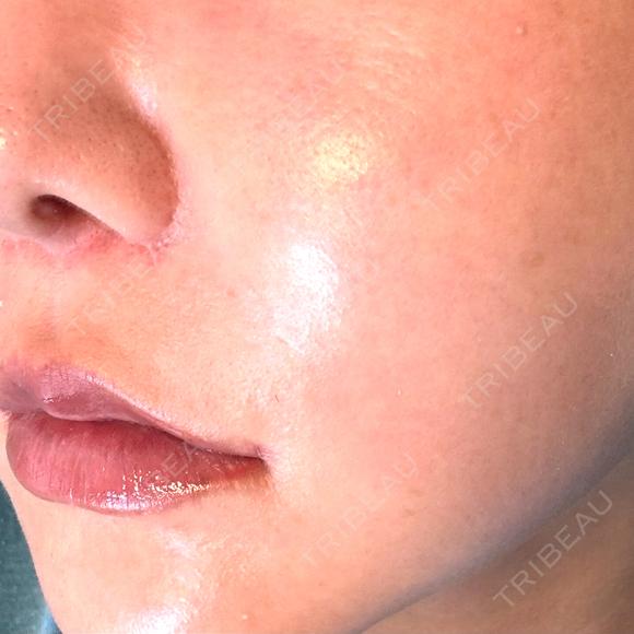 脂肪溶解注射（顔） WellnessPlus Clinic 【ウェルネスプラスクリニック】 DAY 11 メイン用