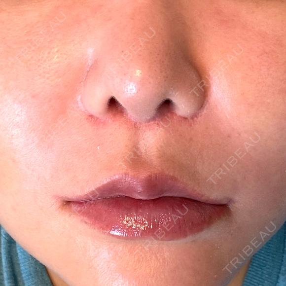 脂肪溶解注射（顔） WellnessPlus Clinic 【ウェルネスプラスクリニック】 DAY 11 メイン用