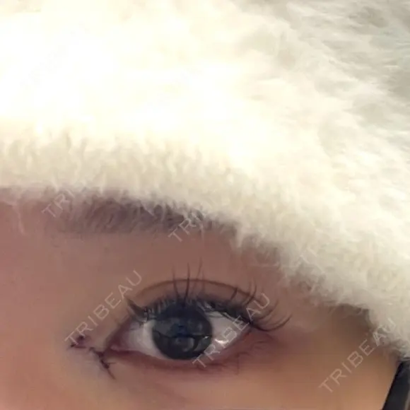 目頭切開 9BeautyClinic DAY 0 メイン用