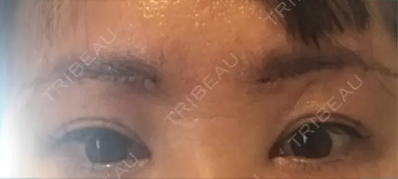 眉下切開 銀座リシェスクリニック DAY 2 メイン用