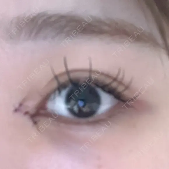 目頭切開 9BeautyClinic DAY 1 メイン用