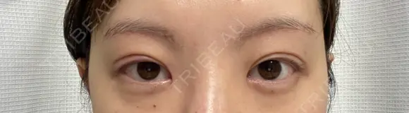 二重切開 / 目頭切開 / 上まぶたの脂肪取り / 眉下切開 タシピウム整形外科 AFTER メイン用