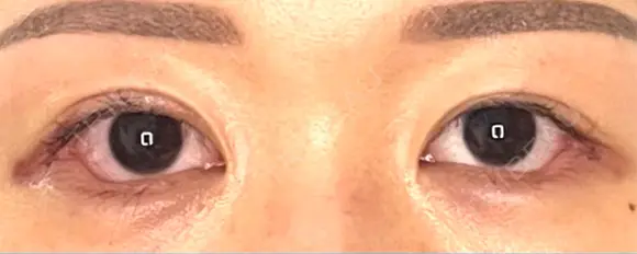 目尻切開 / タレ目形成・グラマラスライン（埋没） LOUIS CLINIC 二子玉川院【ルイクリニック】 DAY 2 メイン用