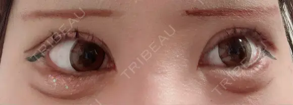 二重切開 / 目頭切開 / 眼瞼下垂（切開） オーキッド美容クリニック東京御徒町 AFTER メイン用